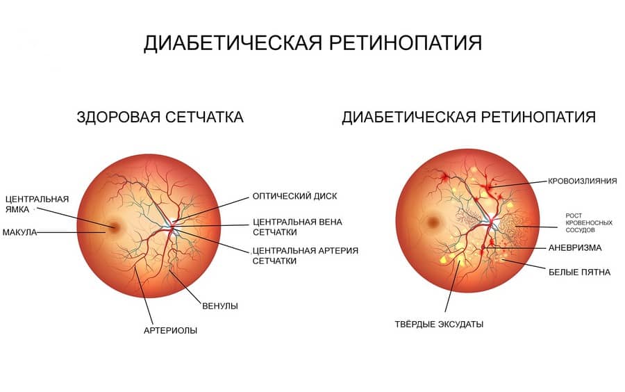 сравнение сетчатки здорового глаза и глаза с диабетической ретинопатией 
